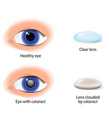 Cloudy eye lens